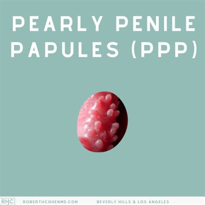 Why do Pearly Penile Papules Exist? The Reason Behind PPP